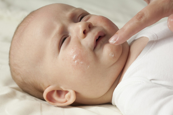 宝宝热疹和湿疹有什么区别？只差一个字，却是两回事