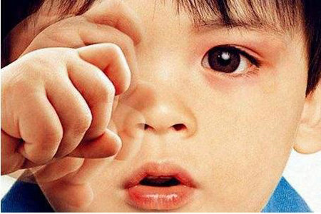 麦粒肿是什么？什么原因引起的呢？