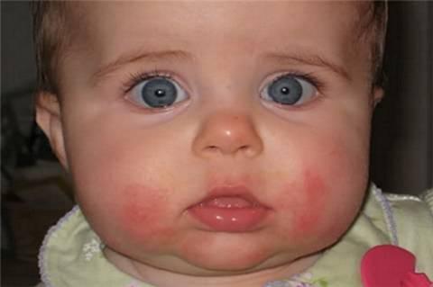 宝宝得了季节性湿疹，妈妈应该如何护理