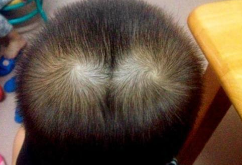 为啥有的孩子头上有2个“旋”关于头旋的奥秘，家长要了解